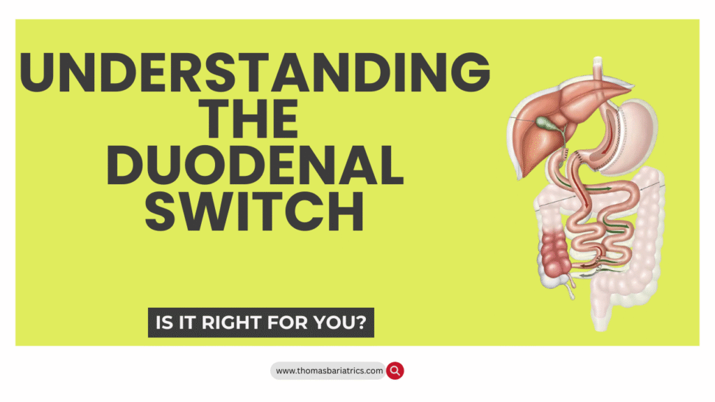 Understanding the Duodenal Switch